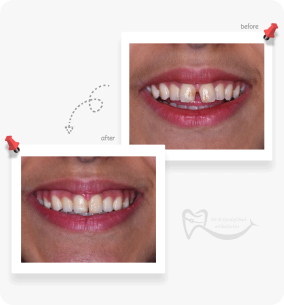 اصلاح طرح لبخند